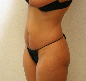 Tummy Tuck