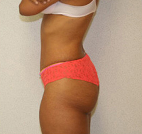 Tummy Tuck