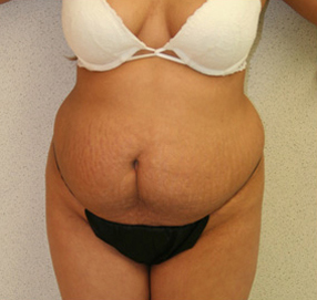 Tummy Tuck