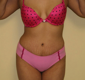 Tummy Tuck