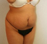 Tummy Tuck