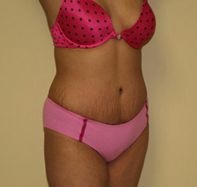 Tummy Tuck