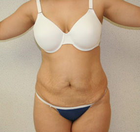 Tummy Tuck