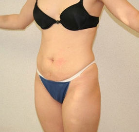 Tummy Tuck