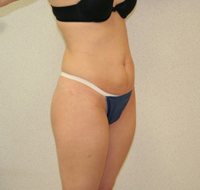 Tummy Tuck