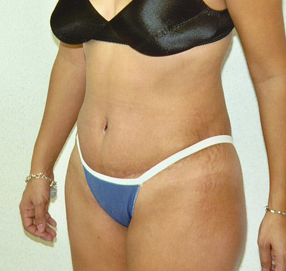 Tummy Tuck