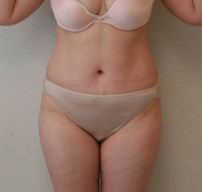 Tummy Tuck