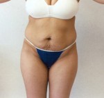 Tummy Tuck