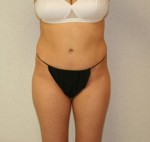 Tummy Tuck