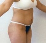 Tummy Tuck