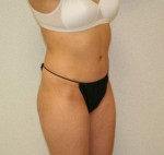 Tummy Tuck