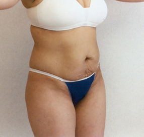 Tummy Tuck