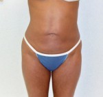 Tummy Tuck