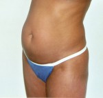 Tummy Tuck