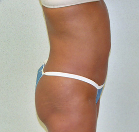 Tummy Tuck