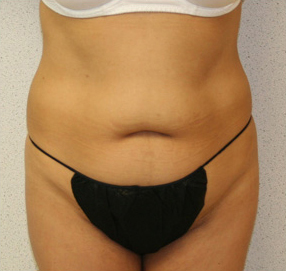 Tummy Tuck