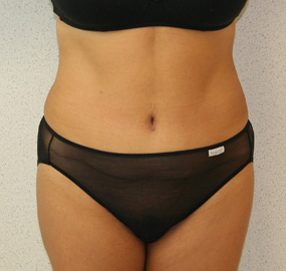 Tummy Tuck