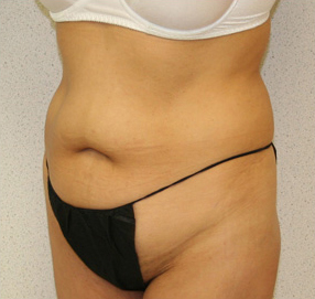 Tummy Tuck