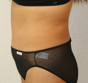 Tummy Tuck