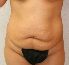 Tummy Tuck