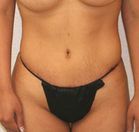 Tummy Tuck