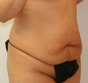 Tummy Tuck