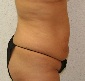 Tummy Tuck