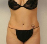 Tummy Tuck