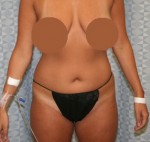 Liposuction