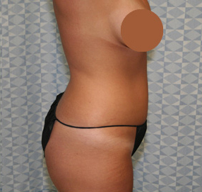 Liposuction