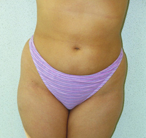 Liposuction