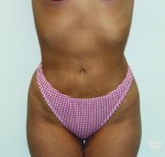 Liposuction