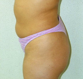 Liposuction