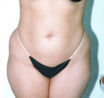 Liposuction