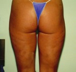 Liposuction