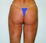 Liposuction