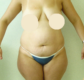 Liposuction