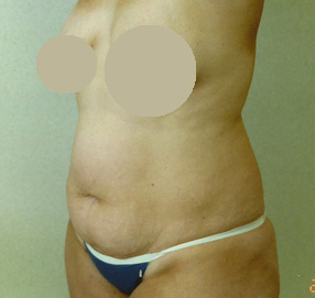 Liposuction