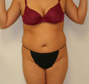 Liposuction Results Chicago