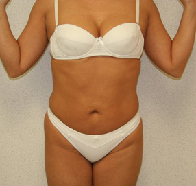 Liposuction Results Chicago