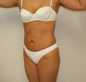 Liposuction