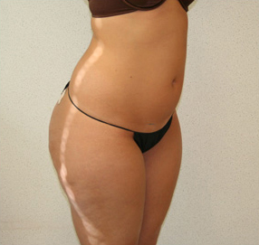 Liposuction