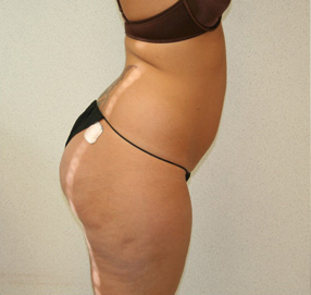 Liposuction