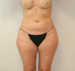 Liposuction