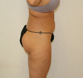 Liposuction