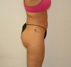 Liposuction