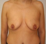 Breast Augmentation