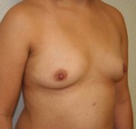 Breast Augmentation