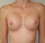 Breast Augmentation