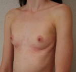 Breast Augmentation